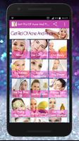 Skin Treatment - Get Rid Of Ac