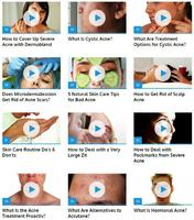 How to Get Rid of Acne