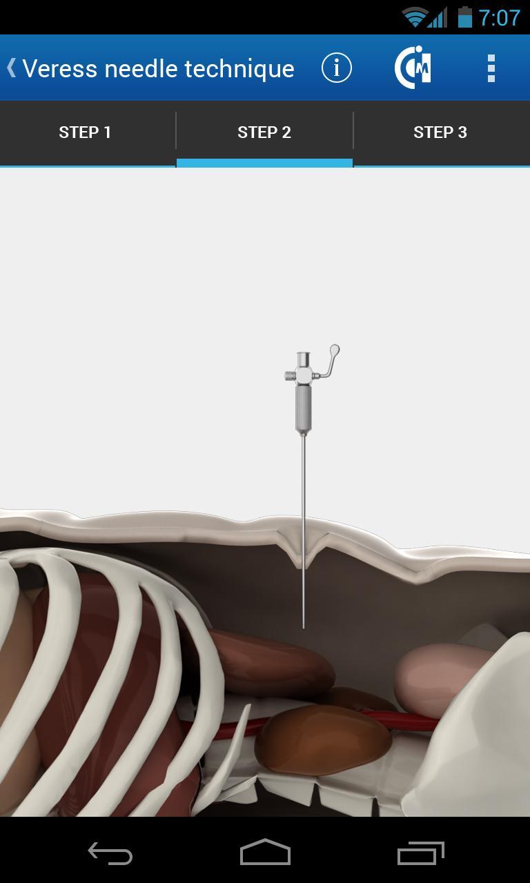 Pneumoperitoneum in humans