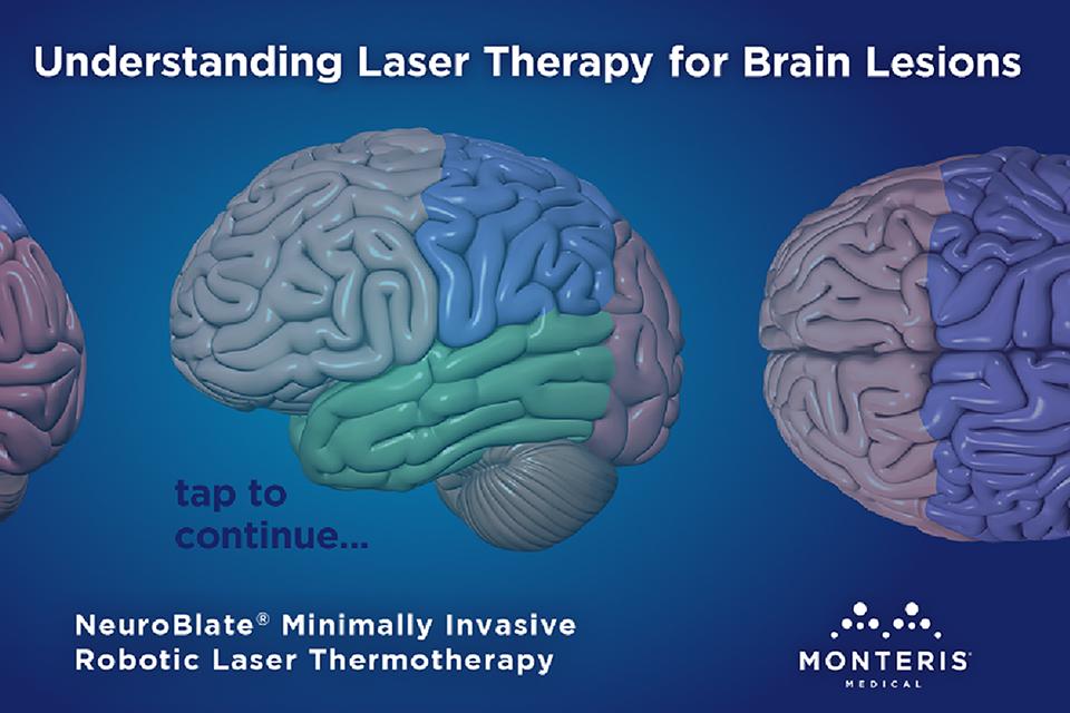 Laser Therapy