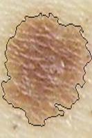 Skin Cancer Image Viewer